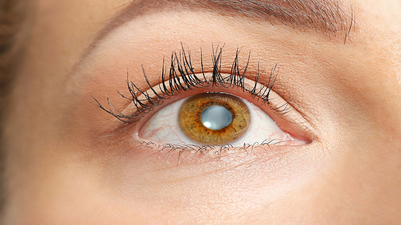 Также о развитии катаракты свидетельствуют