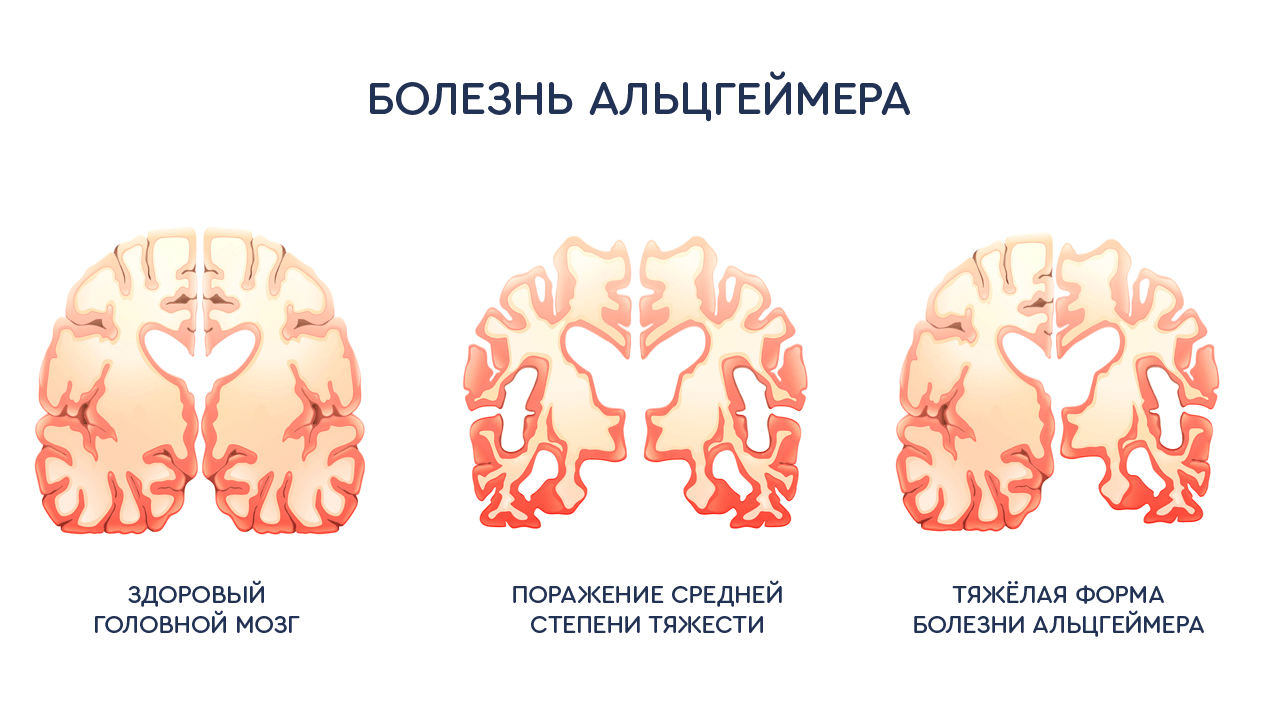 вида болезни альцгеймера