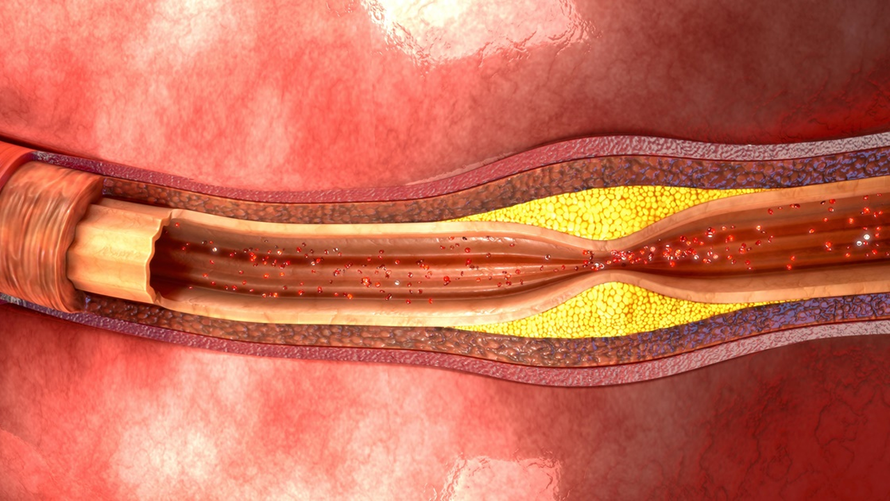 Одной_из_главных_причин_проблем_с_сердцем_считается_атеросклероз
