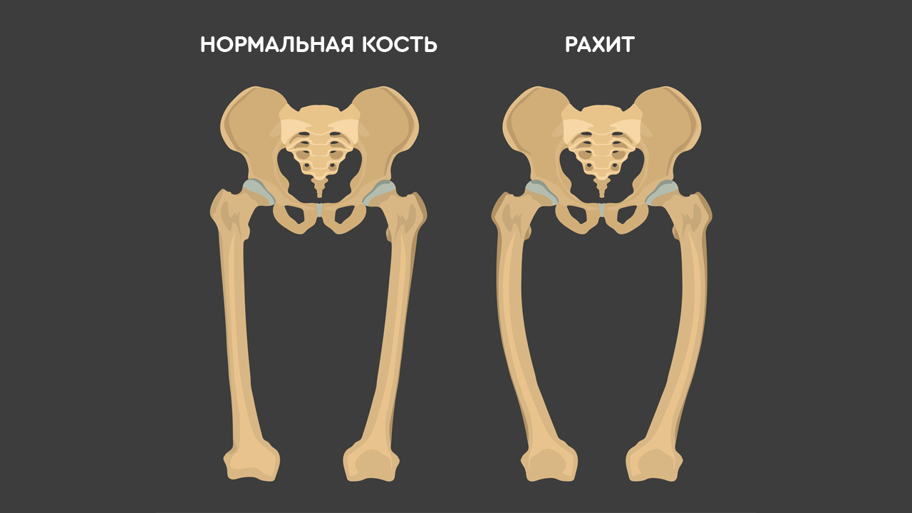 рахит