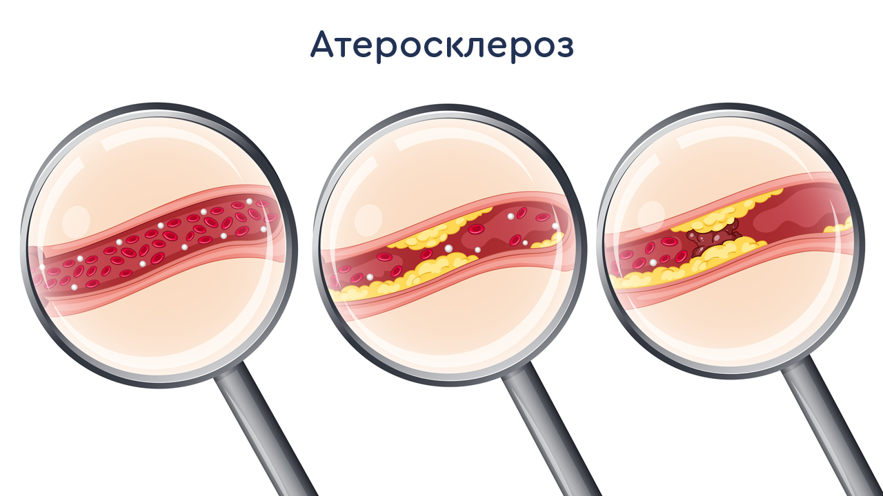 причины атерорслероза