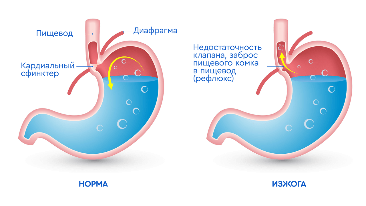 желудок при изжоге