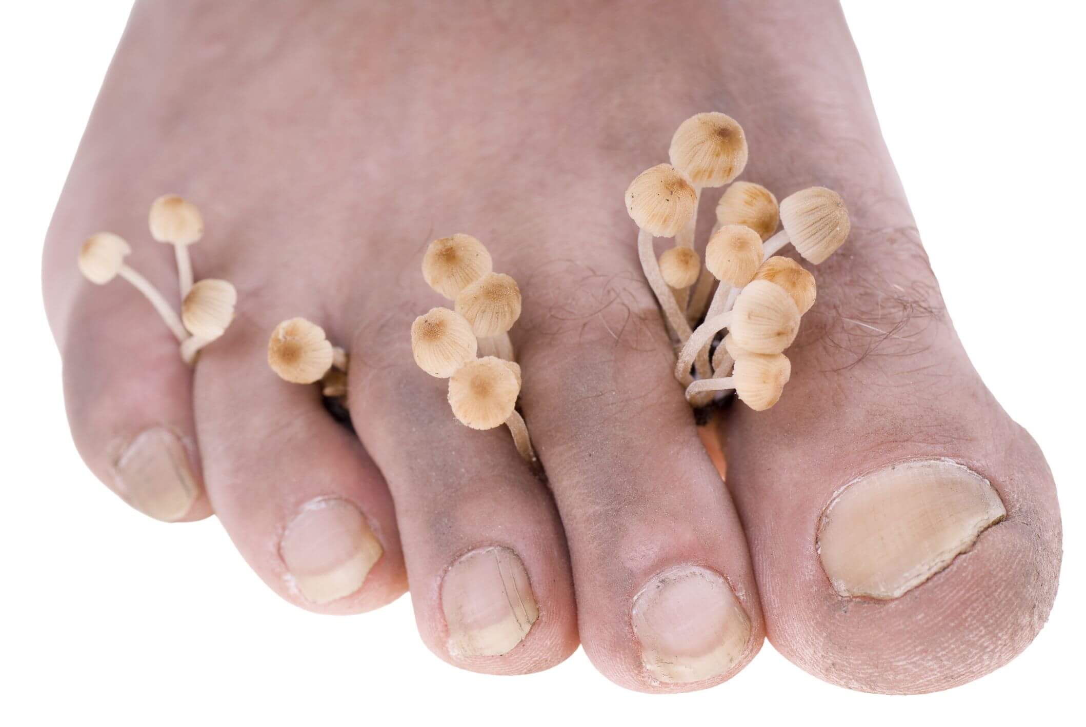 Основные причины появления грибка ногтей, симптомы и факторы риска